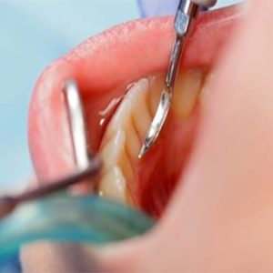 Occlusion